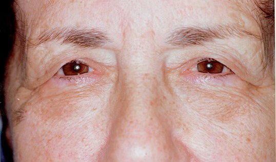 male before blepharoplasty surgery with sagging looking eyes