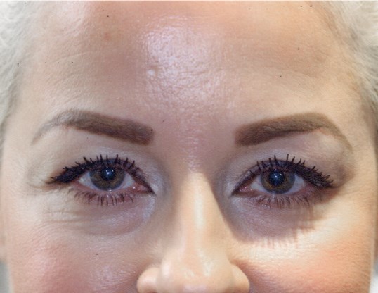 botox injections on the middle and upper face