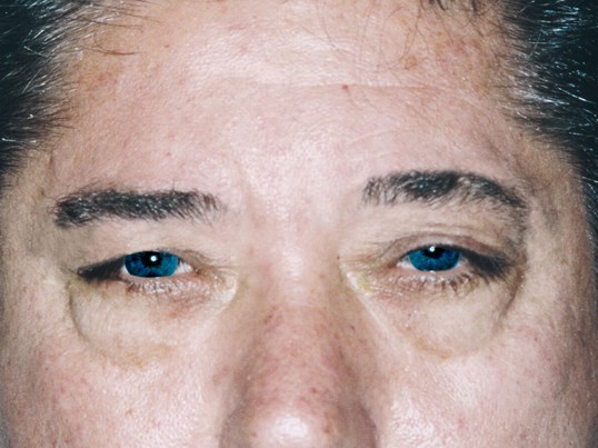 male patient with bright blue eyes before blepharoplasty surgery