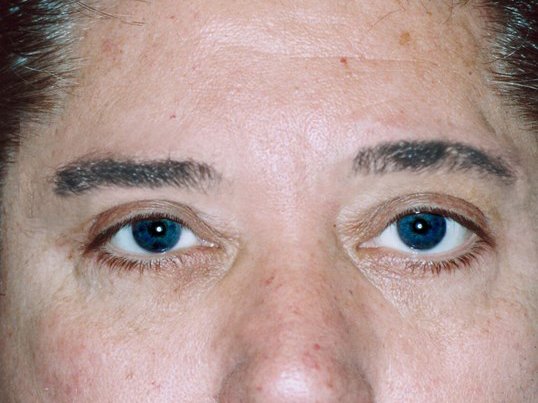 male looking forward after blepharoplasty surgery