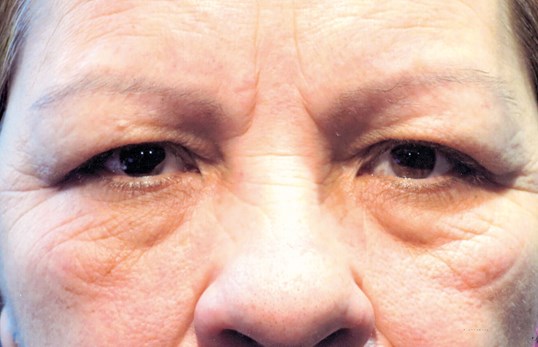 female patient with sagging looking eyes before blepharoplasty surgery