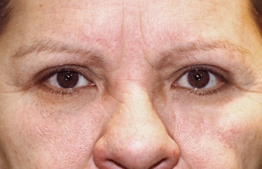 blepharoplasty results on womam