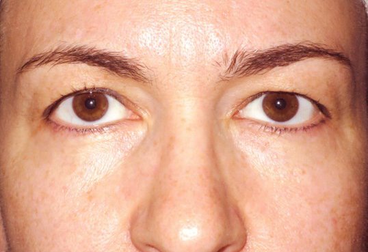 female patient after blepharoplasty fresh looking eyes