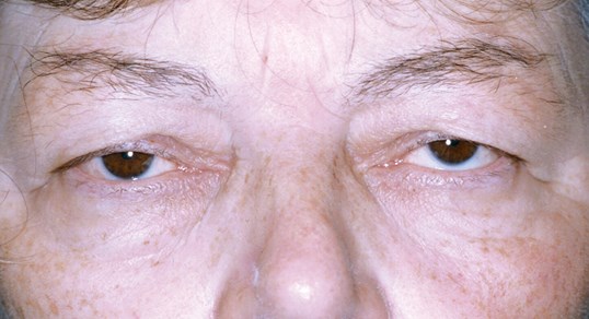 male patient with sagging looking eyes before blepharoplasty surgery