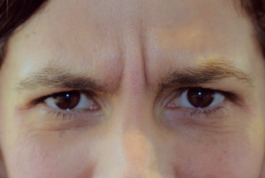 upper face wrinkles on woman forehead before restylane