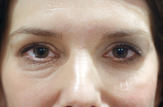 female patient with blepharoplasty results
