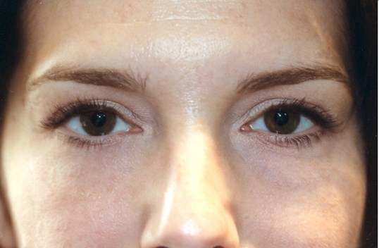 blepharoplasty surgery on female patient