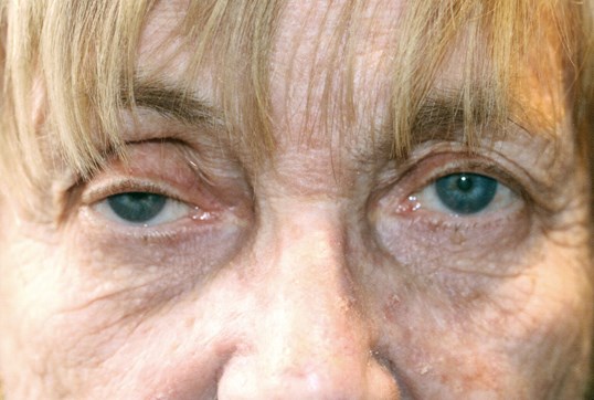 female patient without ptosis repair