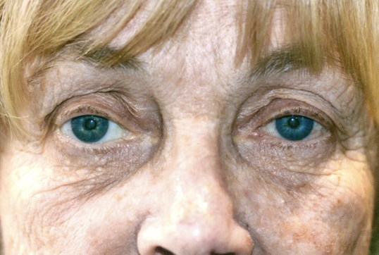 older female patient undergoing ptosis repair