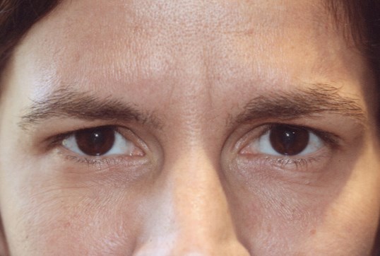 Woman upper face after receiving restylane injectable filler treatment