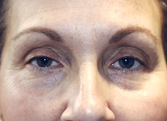 female patients eyes before ptosis repair