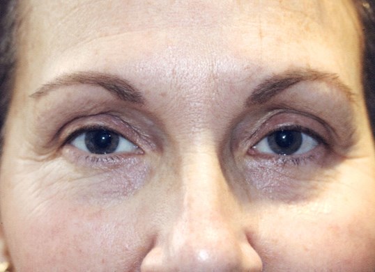 female close up of eyes undergoing ptosis repair