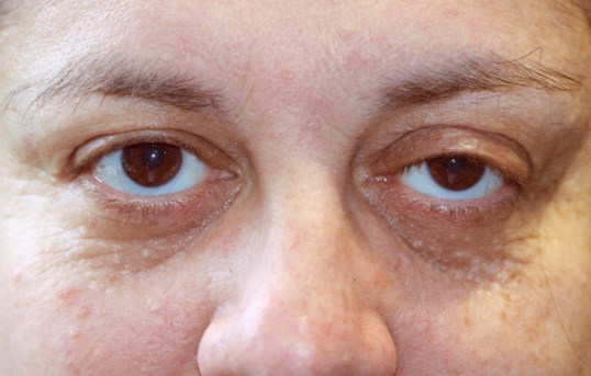 female patients eyes who needs ptosis repair