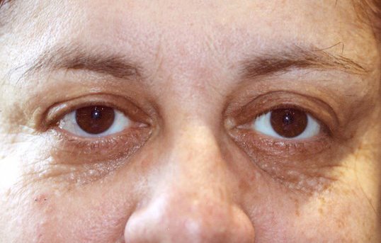 Female patient after ptosis repair surgery at sightmd