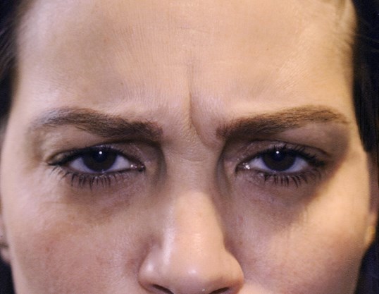 woman with wrinkles on nose and between eyebrows before botox
