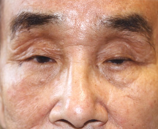 male patient who needs ptosis repair