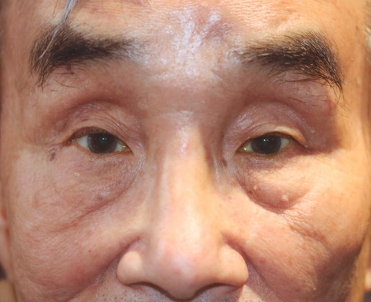 male patient close up of eyes undergoing ptosis repair surgery