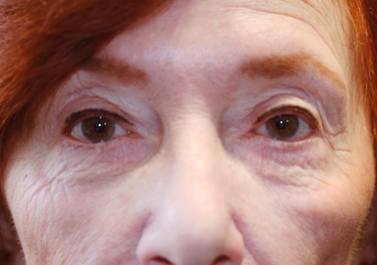 Close up of female patients eyes after ptosis repair