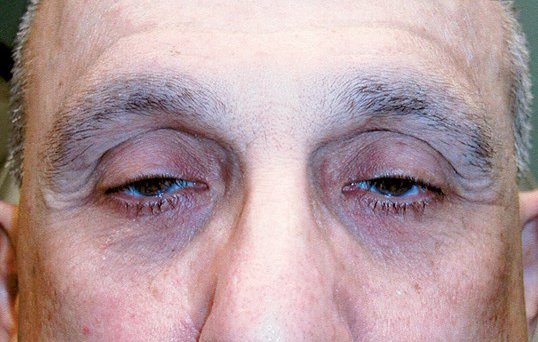 ptosis repair surgery needed on male patient
