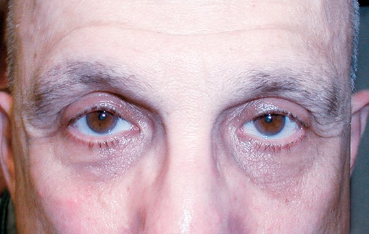 close up of males eyes after ptosis repair surgical procedure