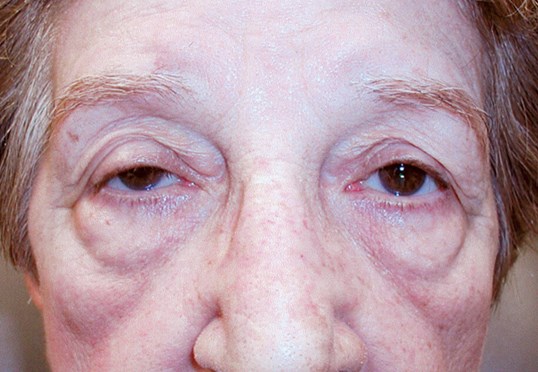 female older patient who requires ptosis repair surgery