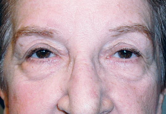 males eyes after ptosis repair surgical procedure