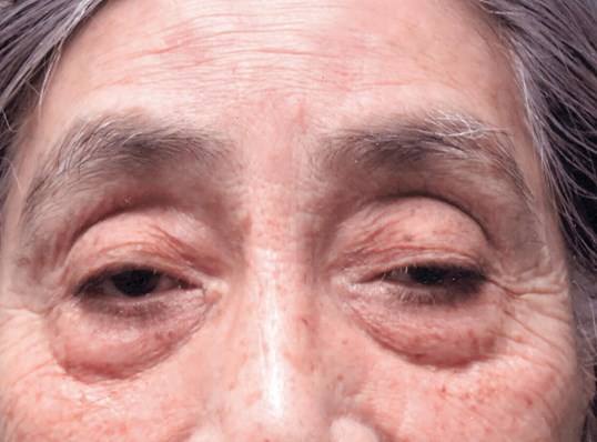 female patient before going through ptosis repair surgery at sightmd