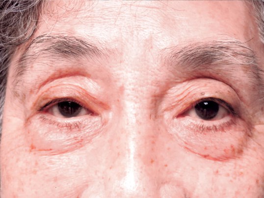 male patients eyes undergoing ptosis repair surgery