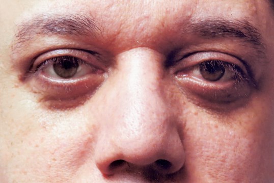 males patient eyes after ptosis repair surgery at sightmd