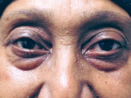 female close up of patients eyes after ptosis surgery