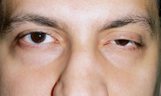male patient before ptosis repair at sight MD