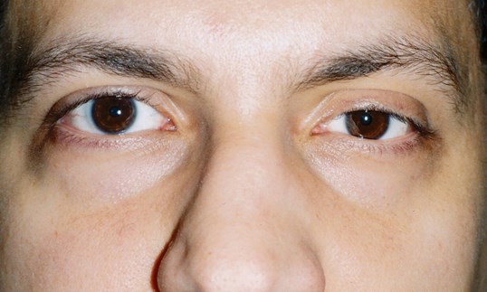 male patient undergoing ptosis surgery repair at sightmd