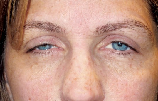 female patient at sight MD before ptosis repair