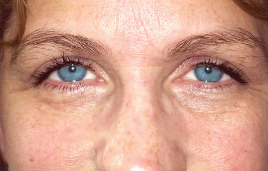 female with bright blue eyes undergoing ptosis repair