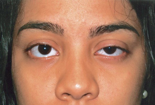 female patient at sight MD before going through ptosis repair surgery