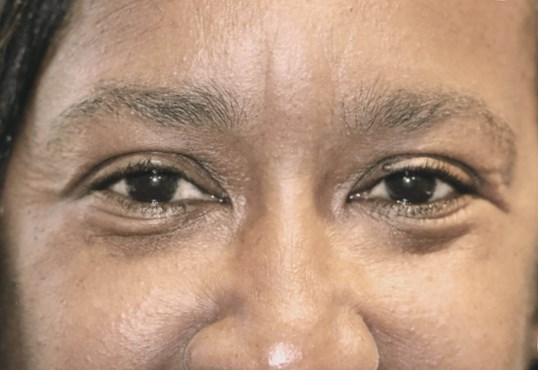 before botox wrinkles on female patient upper face