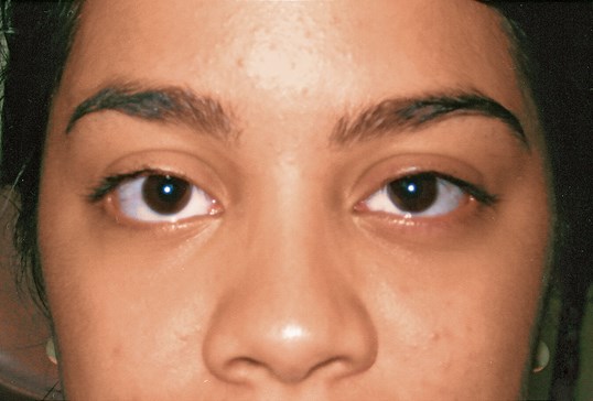 ptosis repair on female patient at sightmd