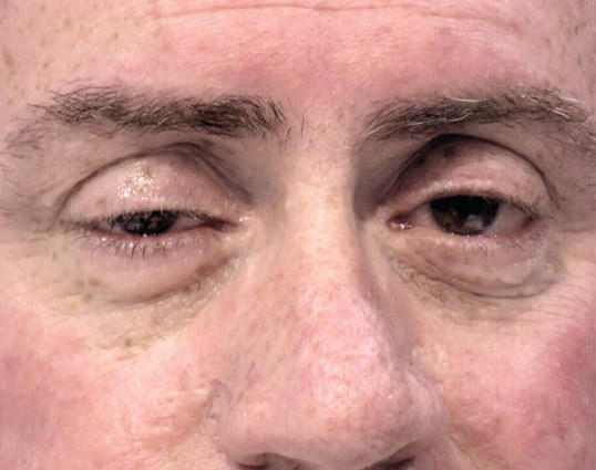 male patient close up of eyes before ptosis repair surgery