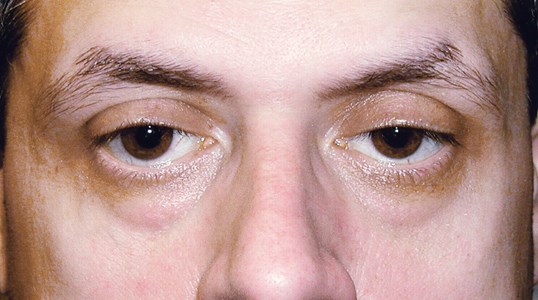 patient close up of eyes before going through ptosis repair