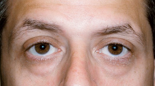 results of ptosis repair at sightmd on male patient