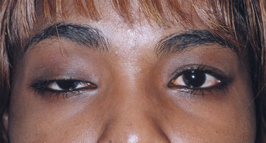 ptosis eye repair surgery before on female patient