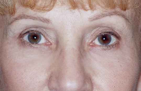 female close up results of ptosis repair surgery