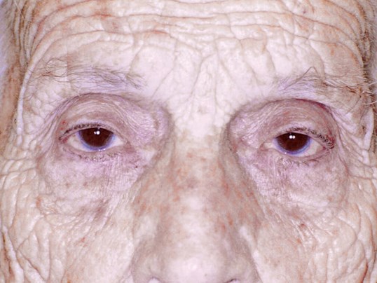 male older patient before undergoing ptosis eye repair