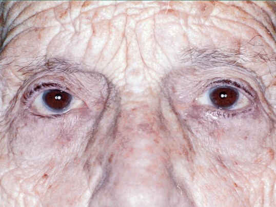 older male ptosis repair results from sightmd