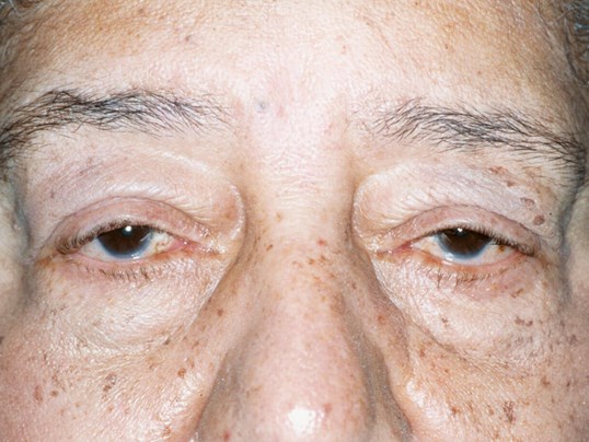 older male patient close up of eyes before ptosis treatment