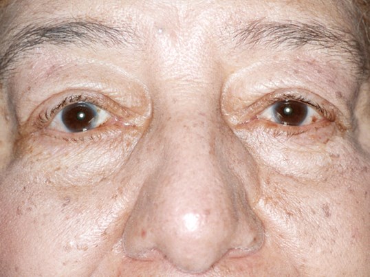 male ptosis repair surgery results from dr. James Gordon