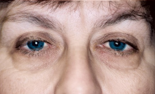 close up of female eyes before ptosis repair treatment