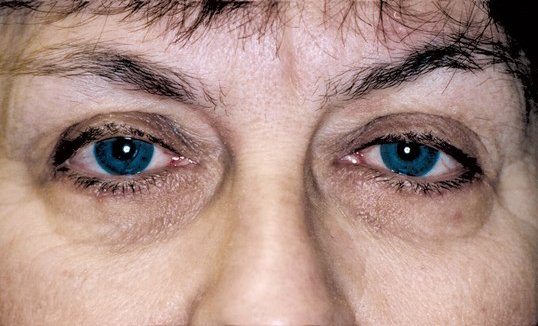 female patient ptosis results at sightmd
