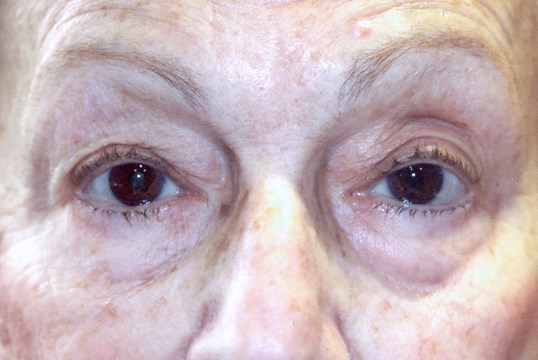 close up of older female patients eyes following ptosis repair