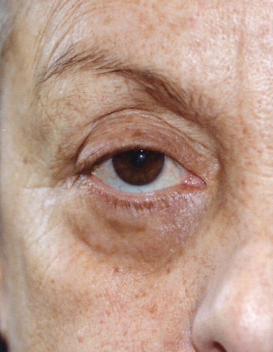 close up of male patient eye following ptosis repair